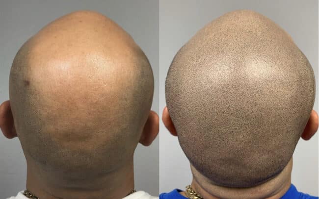 scalp micropigmentation in Demarest nj
