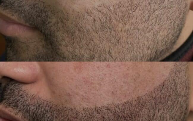 beard micropigmentation in Cresskill nj